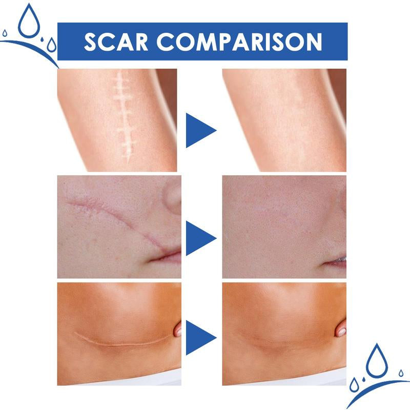 Professional Scar Removal Gel- Scarremoval Treatment for Keloids, C-Sections, Surgeries, Burns, Acne Andmore.