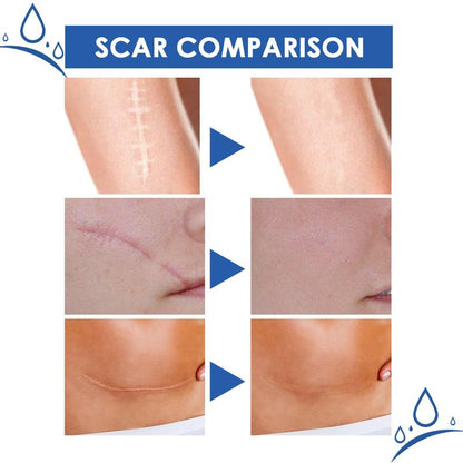 Professional Scar Removal Gel- Scarremoval Treatment for Keloids, C-Sections, Surgeries, Burns, Acne Andmore.